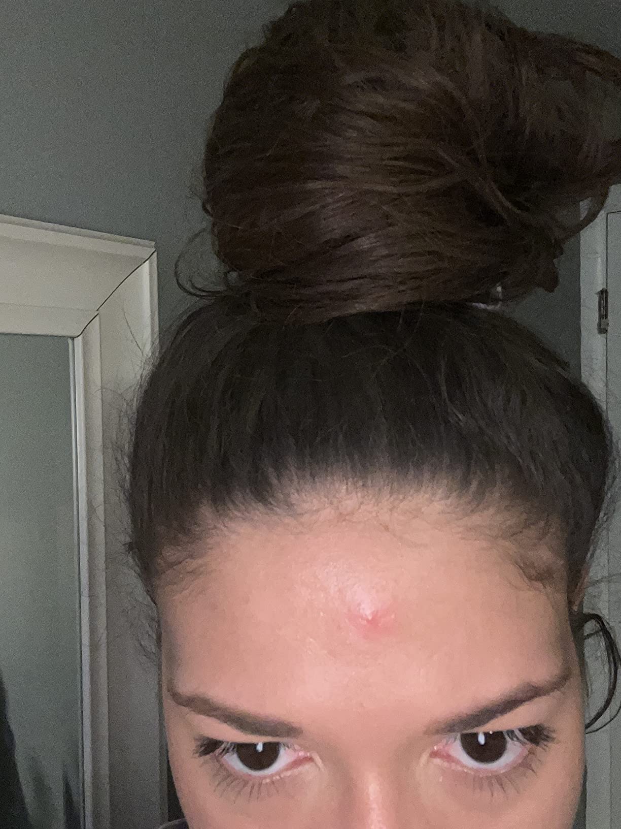 Customer photo of a small red bump on the forehead near the hairline